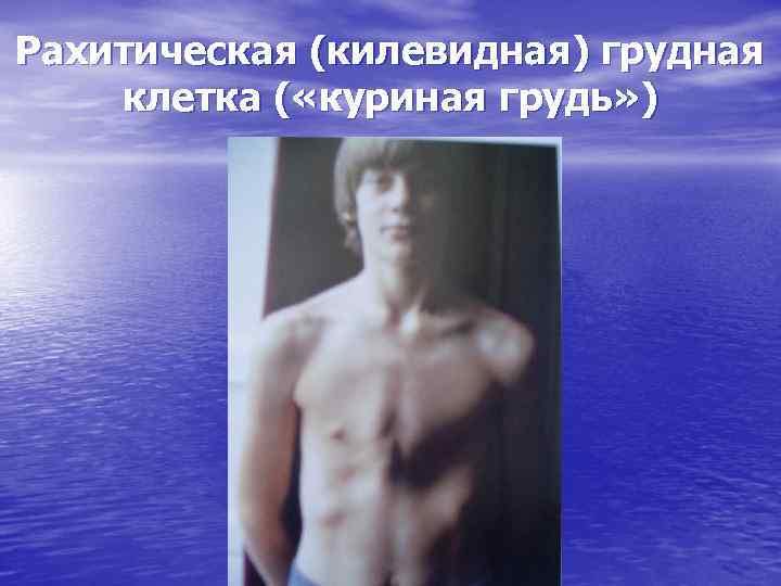 Рахитическая (килевидная) грудная клетка ( «куриная грудь» ) 