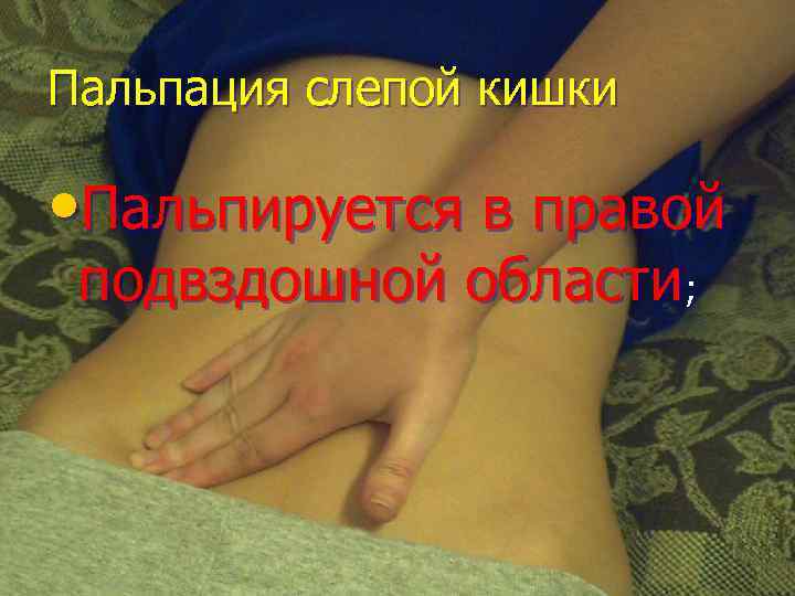 Пальпация слепой кишки • Пальпируется в правой подвздошной области; 