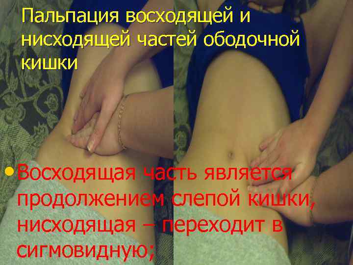 Пальпация восходящей и нисходящей частей ободочной кишки • Восходящая часть является продолжением слепой кишки,