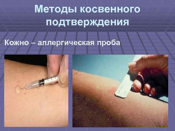 Методы косвенного подтверждения Кожно – аллергическая проба 