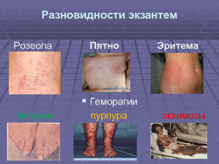 Разновидности экзантем Розеола Пятно Эритема § Геморагии петехии пурпура экхимозы 