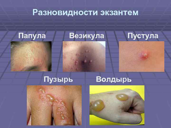 Разновидности экзантем Папула Везикула Пузырь Пустула Волдырь 