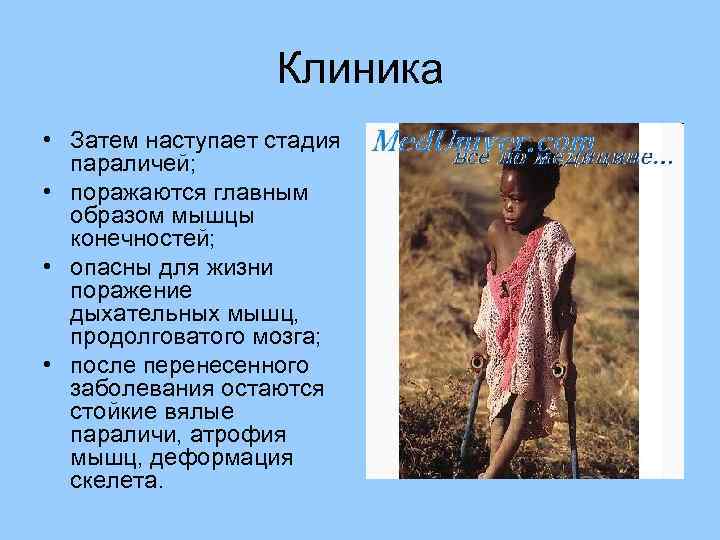 Клиника • Затем наступает стадия параличей; • поражаются главным образом мышцы конечностей; • опасны