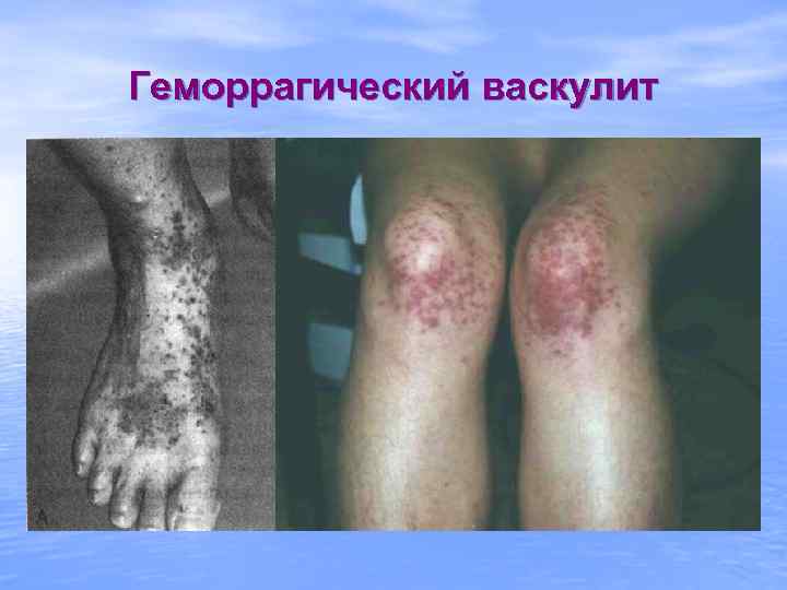 Геморрагический васкулит 