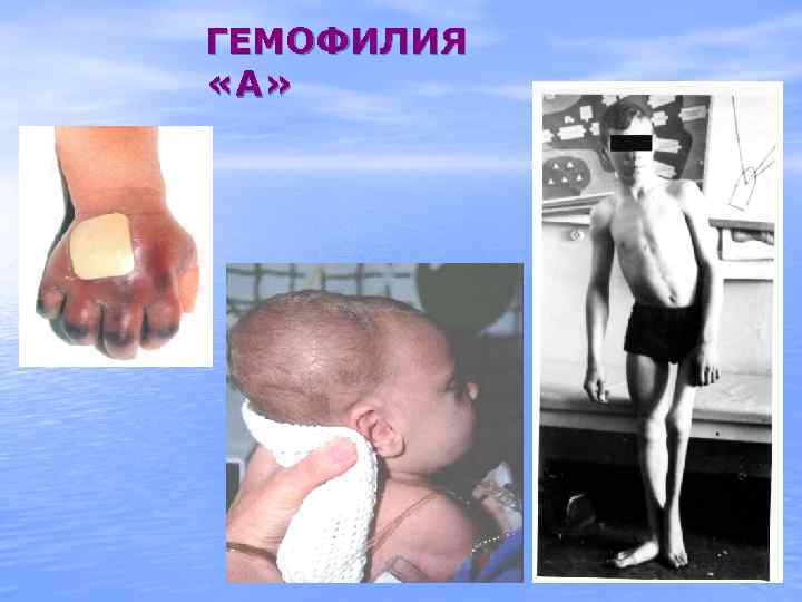 ГЕМОФИЛИЯ «А» 