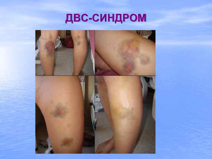 ДВС-СИНДРОМ 