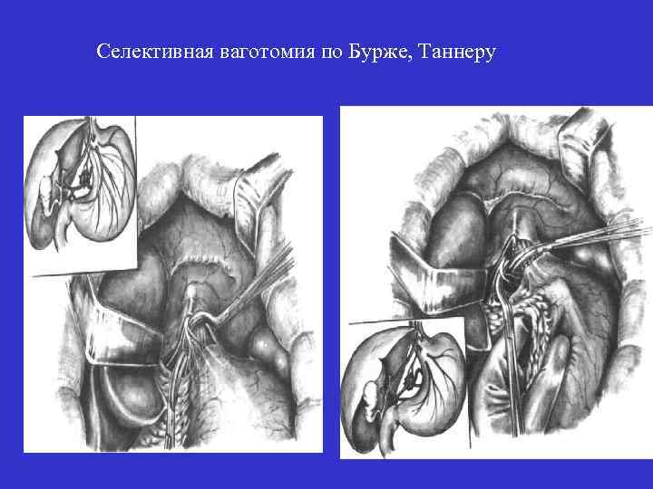 Селективная ваготомия по Бурже, Таннеру 