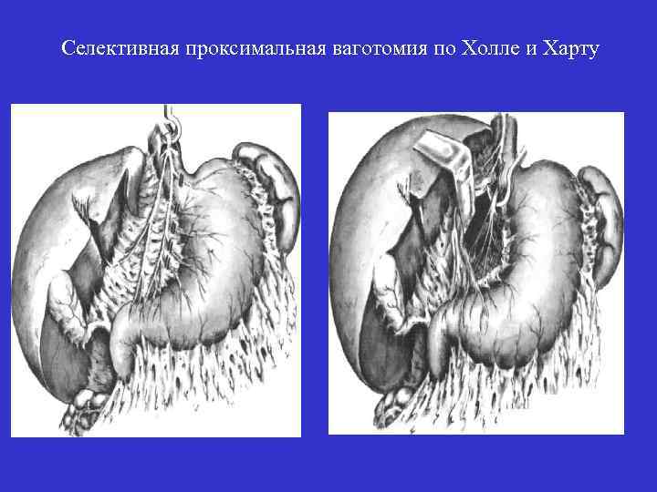 Селективная проксимальная ваготомия по Холле и Харту 