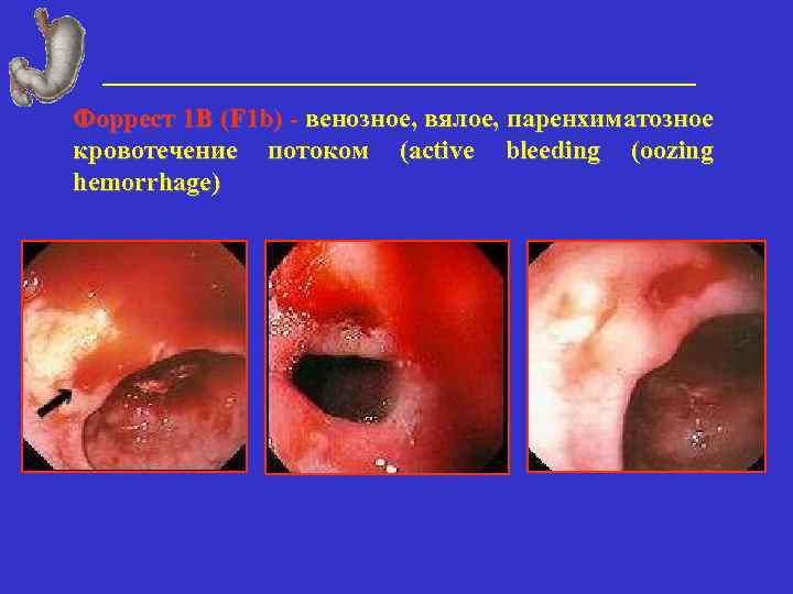 Форрест 1 В (F 1 b) - венозное, вялое, паренхиматозное кровотечение потоком (active bleeding