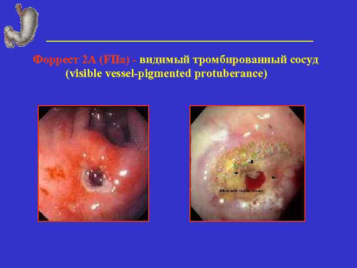 Форрест 2 А (FIIa) - видимый тромбированный сосуд (visible vessel-pigmented protuberance) 