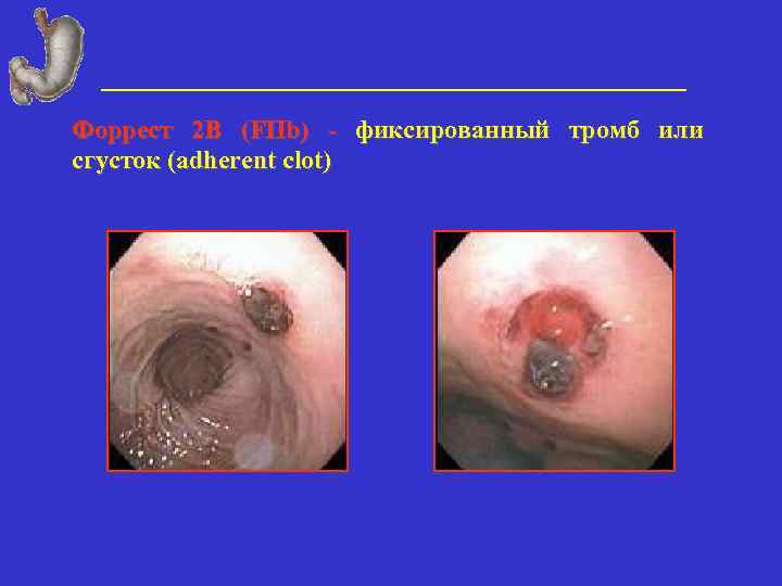 Форрест 2 В (FIIb) - фиксированный тромб или сгусток (adherent clot) 