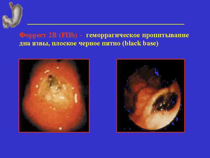 Форрест 2 В (FIIb) - геморрагическое пропитывание дна язвы, плоское черное пятно (black base)