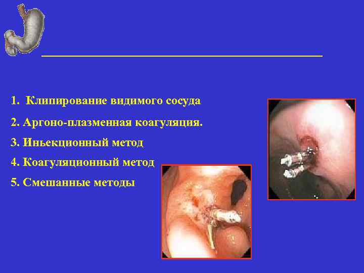 1. Клипирование видимого сосуда 2. Аргоно-плазменная коагуляция. 3. Иньекционный метод 4. Коагуляционный метод 5.