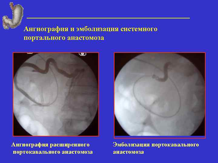 Ангиография и эмболизация системного портального анастомоза Ангиография расширенного портокавального анастомоза Эмболизация портокавального анастомоза 