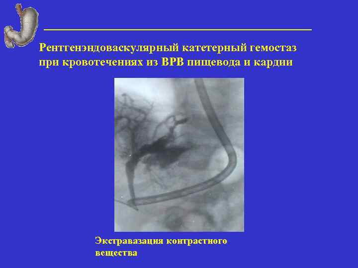 Рентгенэндоваскулярный катетерный гемостаз при кровотечениях из ВРВ пищевода и кардии Экстравазация контрастного вещества 