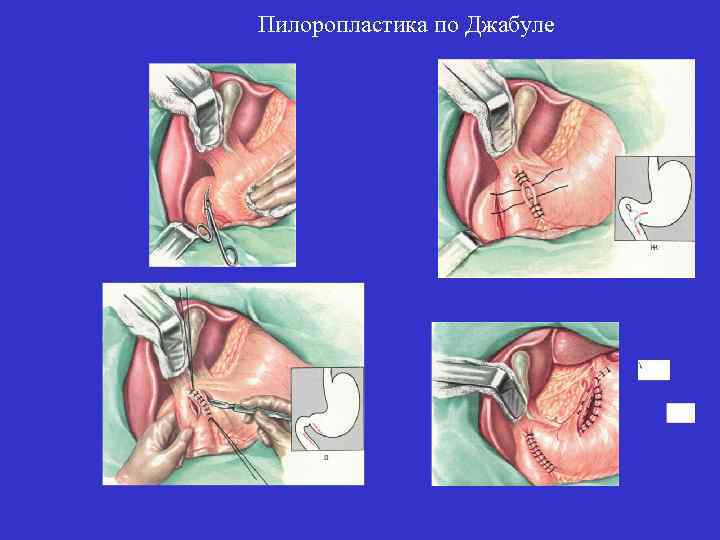 Пилоропластика по Джабуле 