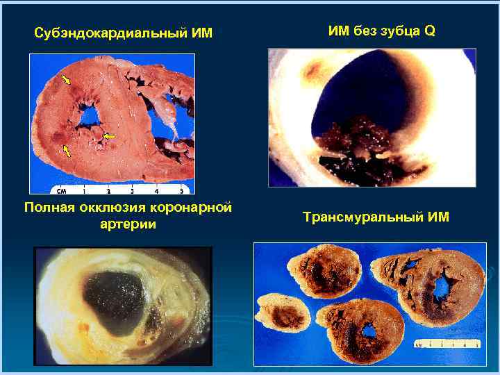 Субэндокардиальный ИМ Полная окклюзия коронарной артерии ИМ без зубца Q Трансмуральный ИМ 