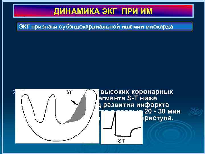 ДИНАМИКА ЭКГ ПРИ ИМ ЭКГ признаки субэндокардиальной ишемии миокарда Ø Характерно появление высоких коронарных