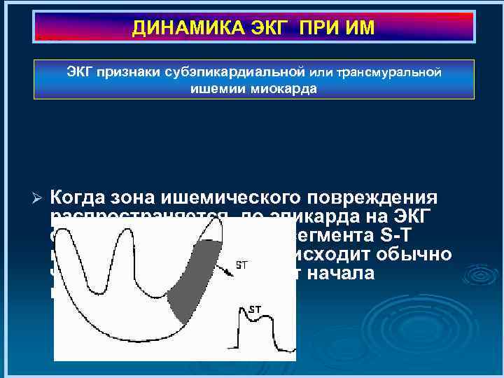 ДИНАМИКА ЭКГ ПРИ ИМ ЭКГ признаки субэпикардиальной или трансмуральной ишемии миокарда Ø Когда зона