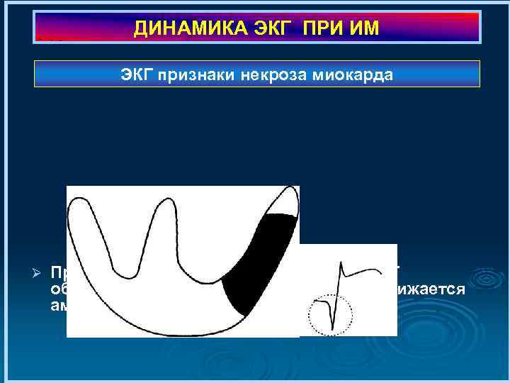 ДИНАМИКА ЭКГ ПРИ ИМ ЭКГ признаки некроза миокарда Ø При формировании зоны некроза на