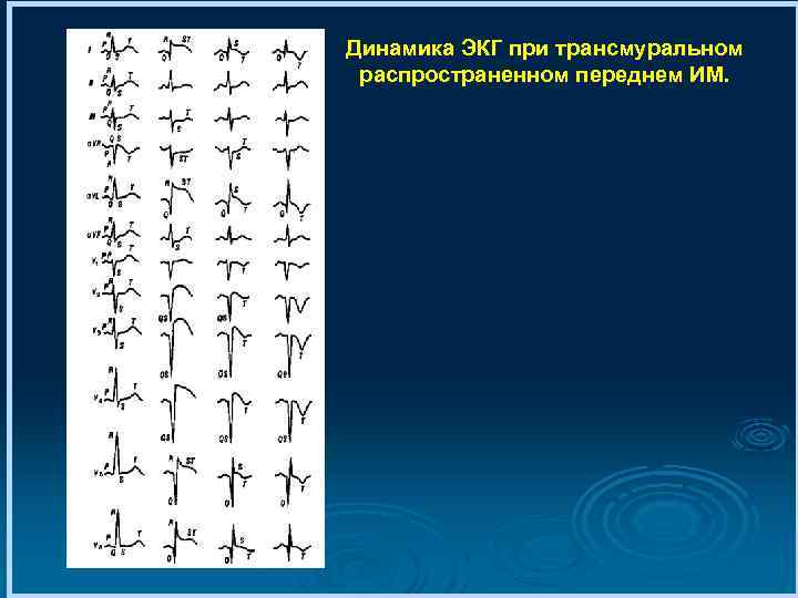 Динамика ЭКГ при трансмуральном распространенном переднем ИМ. 