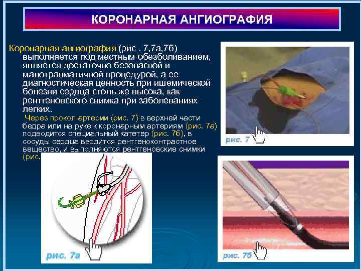 КОРОНАРНАЯ АНГИОГРАФИЯ Коронарная ангиография (рис. 7, 7 а, 7 б) выполняется под местным обезболиванием,