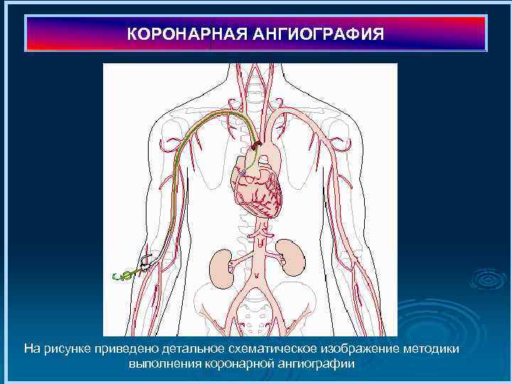 КОРОНАРНАЯ АНГИОГРАФИЯ На рисунке приведено детальное схематическое изображение методики выполнения коронарной ангиографии 