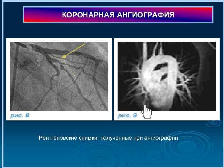 КОРОНАРНАЯ АНГИОГРАФИЯ Рентгеновские снимки, полученные при ангиографии 