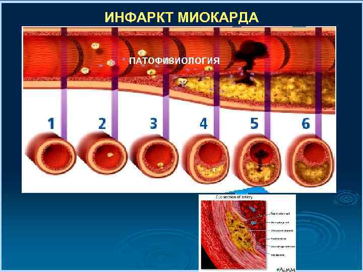 ИНФАРКТ МИОКАРДА ПАТОФИЗИОЛОГИЯ 