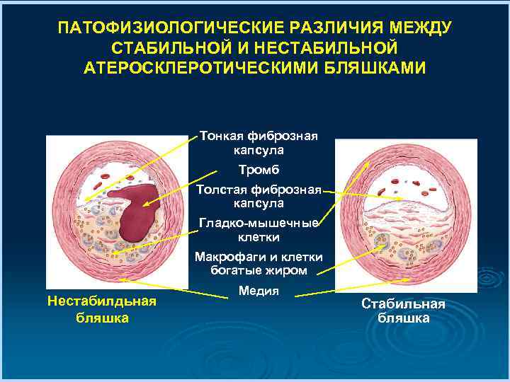 Стабильная атеросклеротическая бляшка. Концепция легкоранимости атеросклеротической бляшки. Нестабильная атеросклеротическая бляшка. Строение стабильной и нестабильной атеросклеротической бляшки. Строение атеросклеротической бляшки.