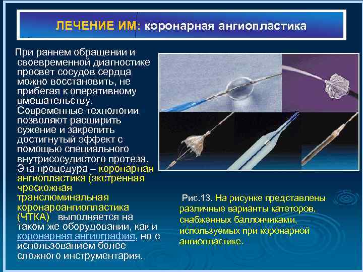 ЛЕЧЕНИЕ ИМ: коронарная ангиопластика При раннем обращении и своевременной диагностике просвет сосудов сердца можно