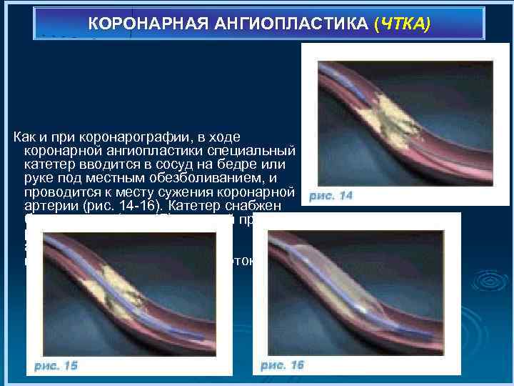 КОРОНАРНАЯ АНГИОПЛАСТИКА (ЧТКА) Как и при коронарографии, в ходе коронарной ангиопластики специальный катетер вводится