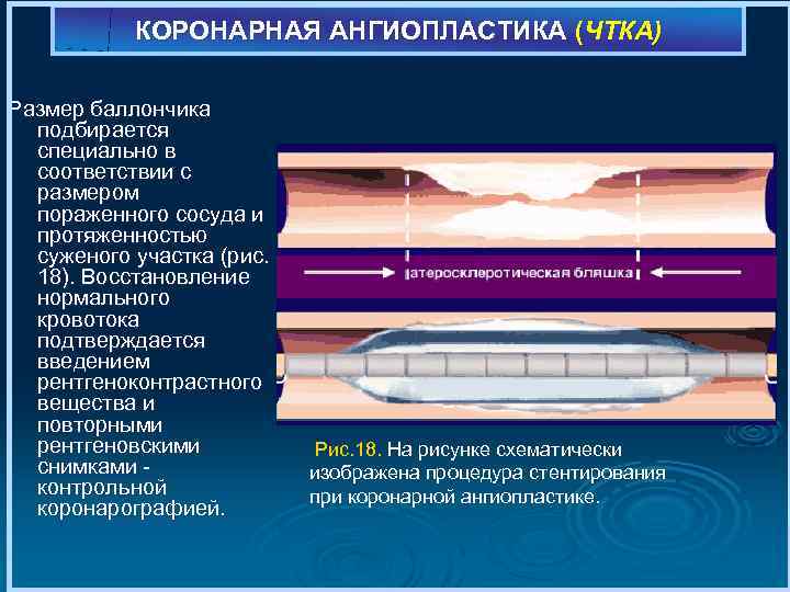 КОРОНАРНАЯ АНГИОПЛАСТИКА (ЧТКА) Размер баллончика подбирается специально в соответствии с размером пораженного сосуда и