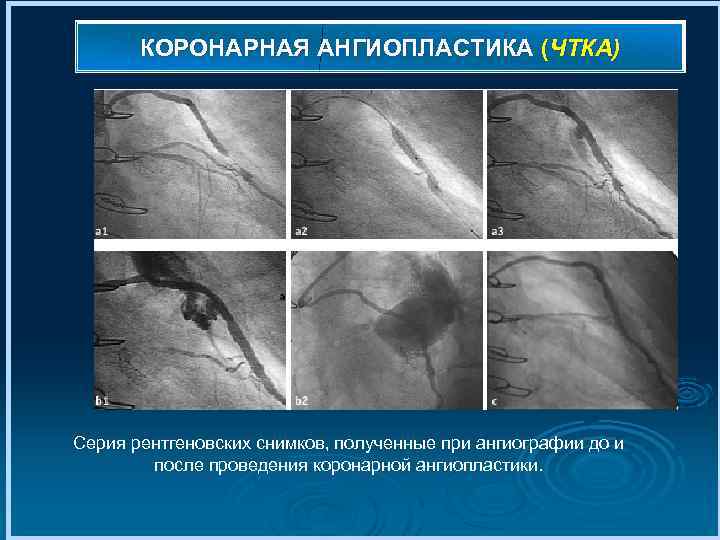 КОРОНАРНАЯ АНГИОПЛАСТИКА (ЧТКА) Серия рентгеновских снимков, полученные при ангиографии до и после проведения коронарной