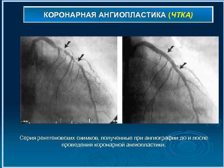 КОРОНАРНАЯ АНГИОПЛАСТИКА (ЧТКА) Серия рентгеновских снимков, полученные при ангиографии до и после проведения коронарной