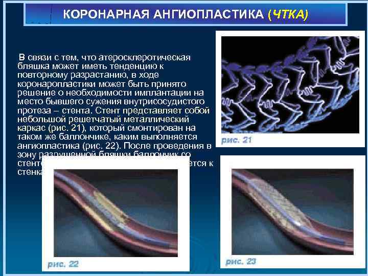 КОРОНАРНАЯ АНГИОПЛАСТИКА (ЧТКА) В связи с тем, что атеросклеротическая бляшка может иметь тенденцию к