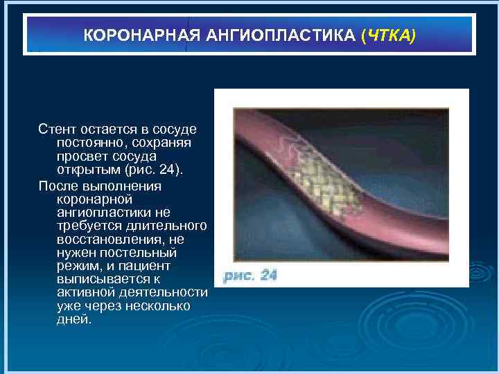 КОРОНАРНАЯ АНГИОПЛАСТИКА (ЧТКА) Стент остается в сосуде постоянно, сохраняя просвет сосуда открытым (рис. 24).