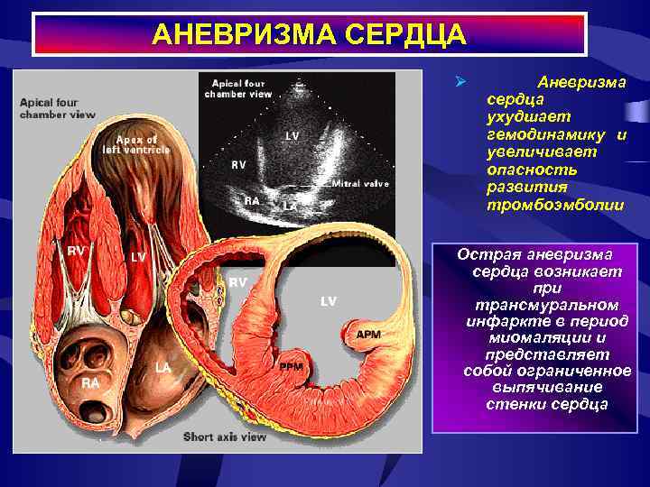 АНЕВРИЗМА СЕРДЦА Ø Аневризма сердца ухудшает гемодинамику и увеличивает опасность развития тромбоэмболии Острая аневризма