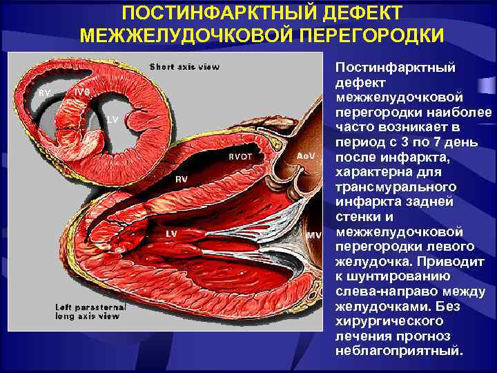 ПОСТИНФАРКТНЫЙ ДЕФЕКТ МЕЖЖЕЛУДОЧКОВОЙ ПЕРЕГОРОДКИ Постинфарктный дефект межжелудочковой перегородки наиболее часто возникает в период с