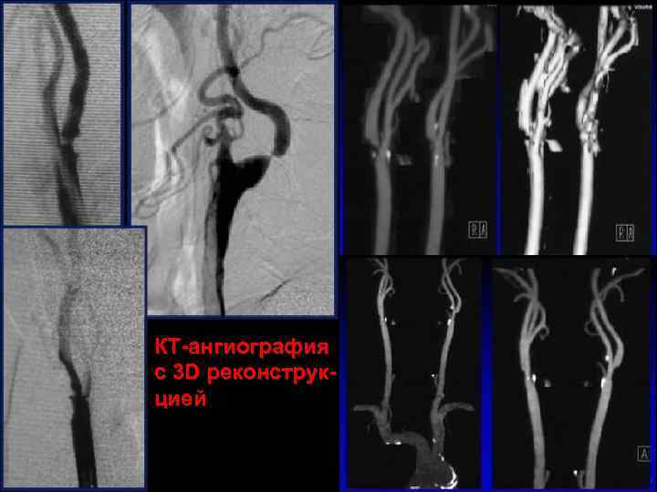 КТ-ангиография с 3 D реконструкцией 