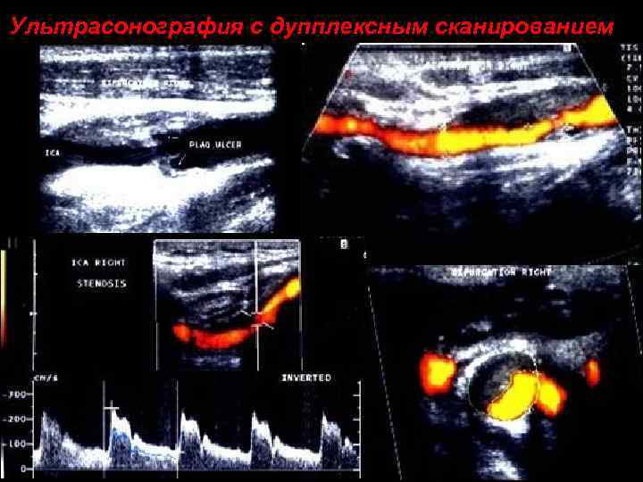 Ультрасонография с дупплексным сканированием 