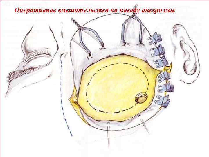 Оперативное вмешательство по поводу аневризмы 