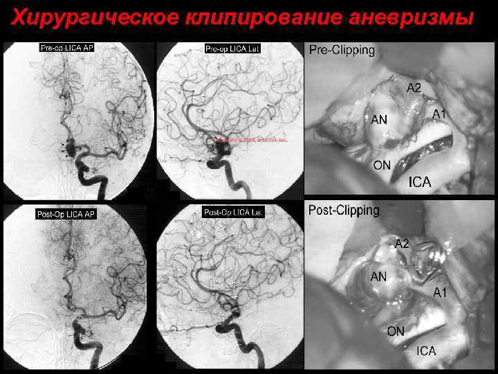 Хирургическое клипирование аневризмы 