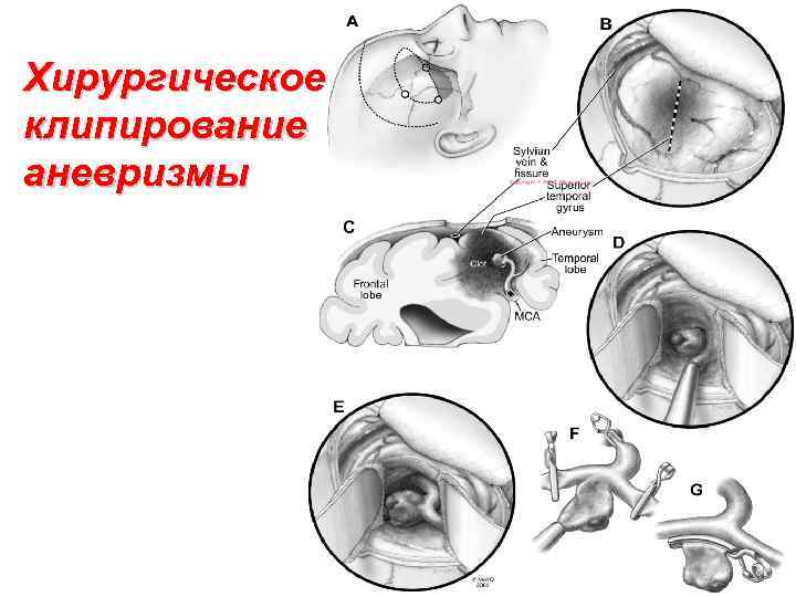 Хирургическое клипирование аневризмы 