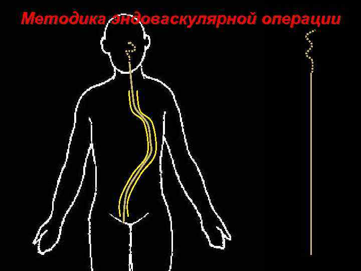 Методика эндоваскулярной операции 