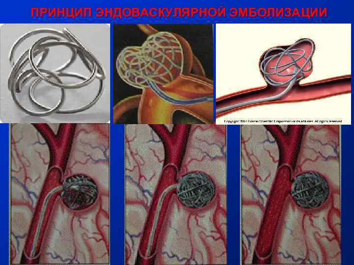 ПРИНЦИП ЭНДОВАСКУЛЯРНОЙ ЭМБОЛИЗАЦИИ 