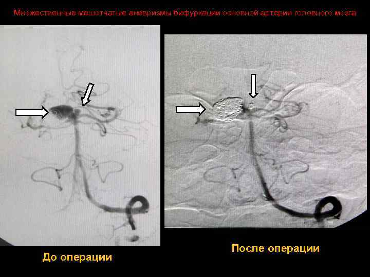 Множественные мешотчатые аневризмы бифуркации основной артерии головного мозга До операции После операции 
