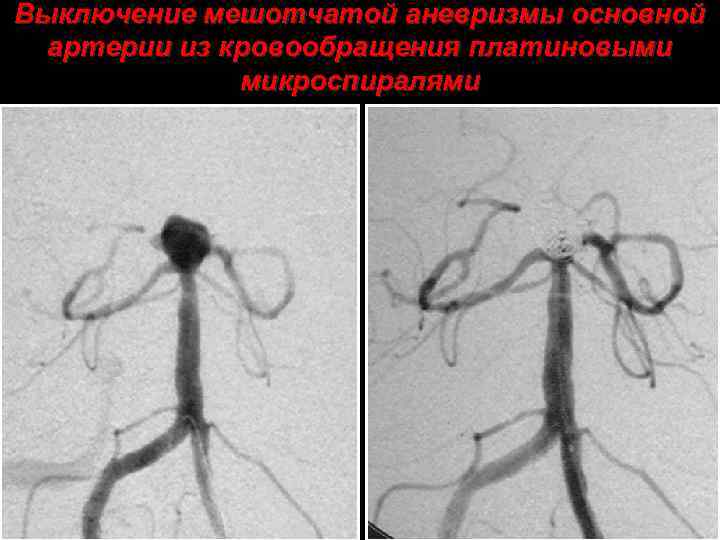 Выключение мешотчатой аневризмы основной артерии из кровообращения платиновыми микроспиралями 