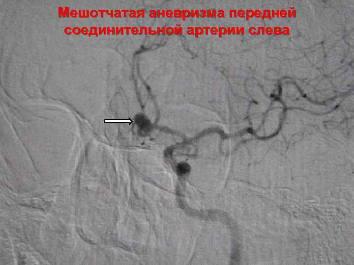 Мешотчатая аневризма передней соединительной артерии слева 