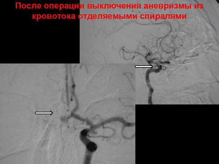 После операции выключения аневризмы из кровотока отделяемыми спиралями 